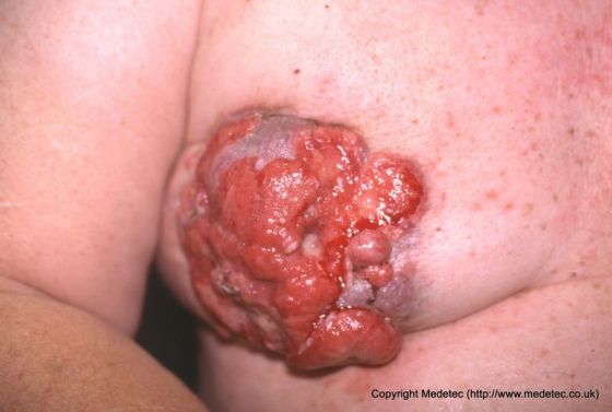 Large fungating malignant breast wound